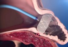 Tirrenia Hospital, un intervento innovativo per prevenire l’ictus: traguardo per l’emodinamica